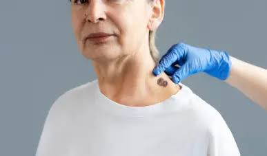 ​HPV também está associado ao câncer de cabeça e pescoço; vacinação ajuda a prevenir