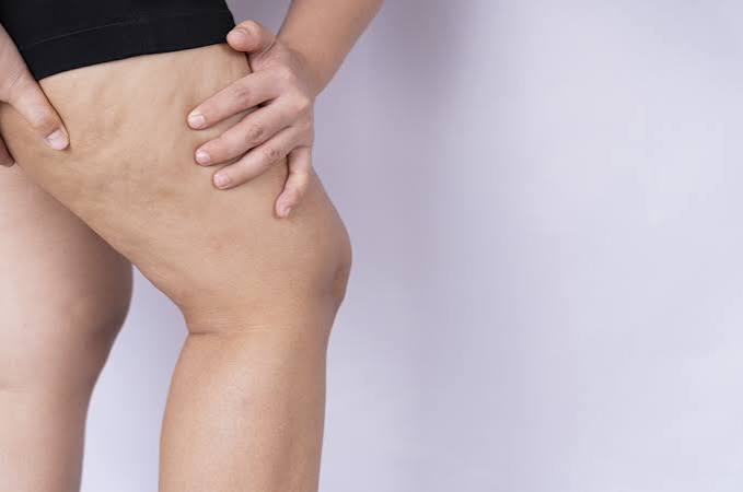 ​Dor nas pernas nem sempre é cansaço: lipedema ainda é pouco conhecido e afeta milhões de mulheres